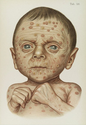 141104_HIST_MedImages_HeredSyphilis.jpg.CROP.original-original.jpg